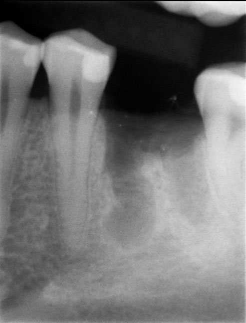 bone loss after extraction