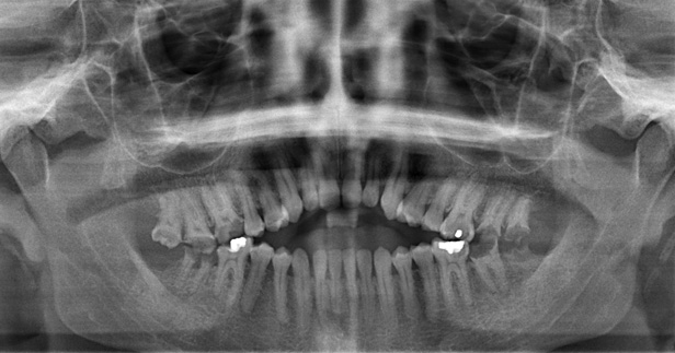 broken down molars