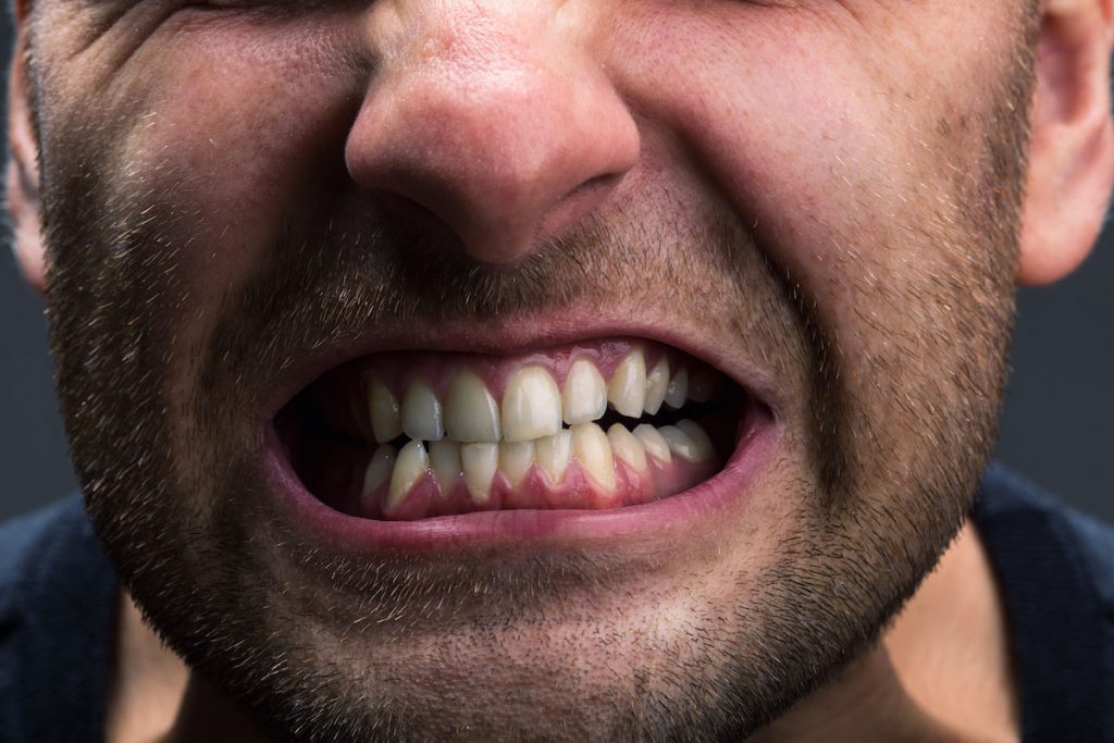 bruxism causes symptoms and solutions