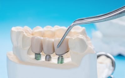 Crowns, Bridges and Veneers – What You Need to Know