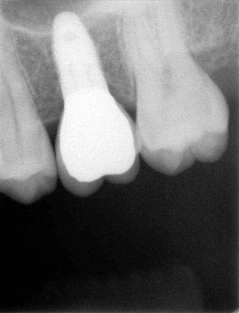 implant with Crown attached