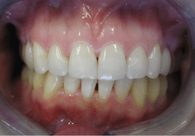 invisalign after