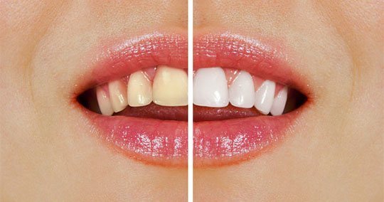 teeth-whitening-applecross