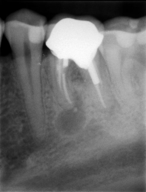 tooth decay under crown
