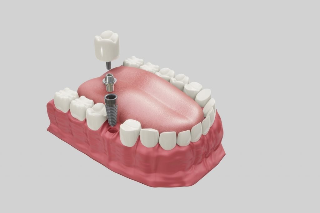 what is a dental implant