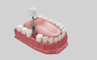 What is a Dental Implant?