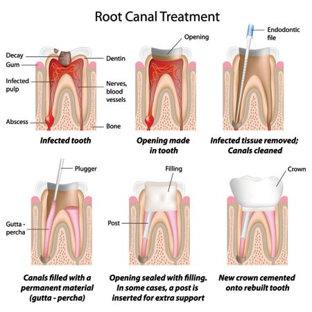 what is root canal treatment applecross