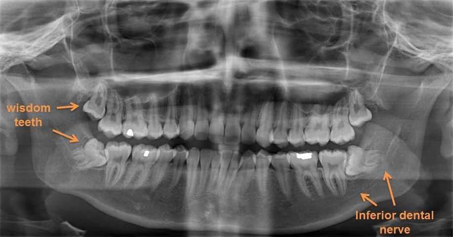 impacted wisdom tooth xray