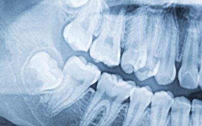 Wisdom Teeth – What Are They and Why Do I Need Them Removed?