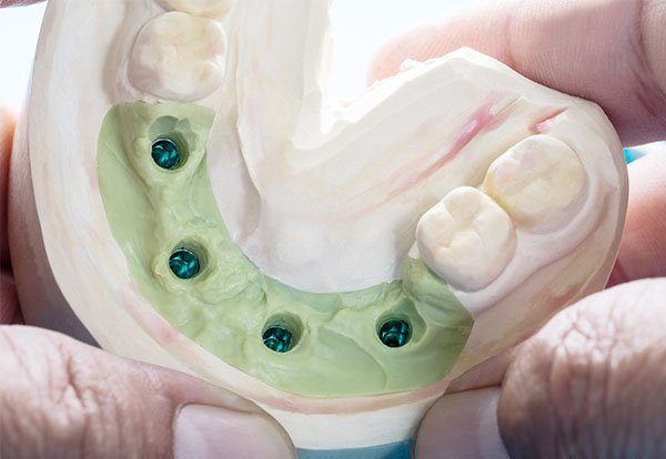 all on 4 dental implants applecross