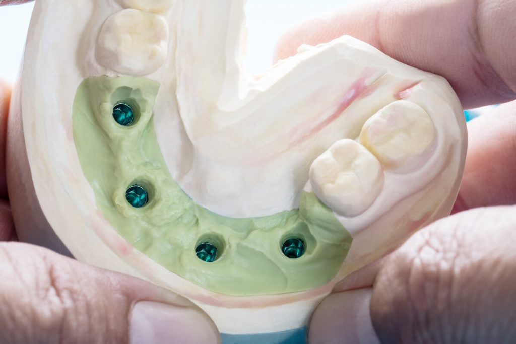 dental implants in applecross should you shop around