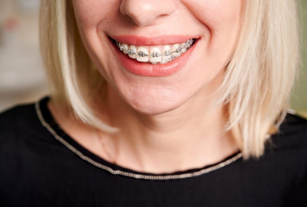 to 6 reasons why you might need braces