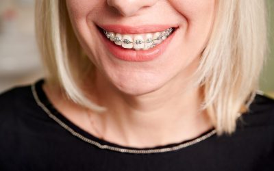Top 6 Reasons Why You Might Need Braces