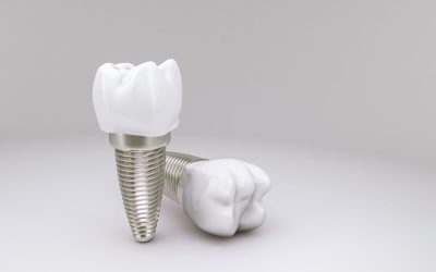 A Permanent Solution: Understanding the Long-Term Benefits of Dental Implants