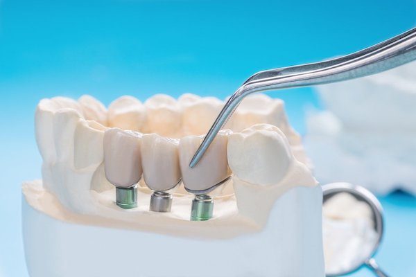 dental crowns and bridges applecross