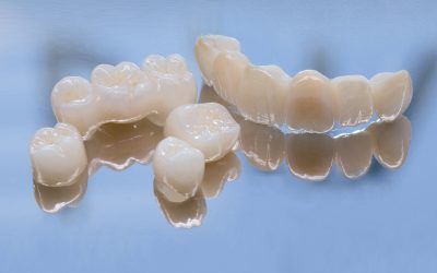 Common Problems with Dental Bridges and How to Handle Them