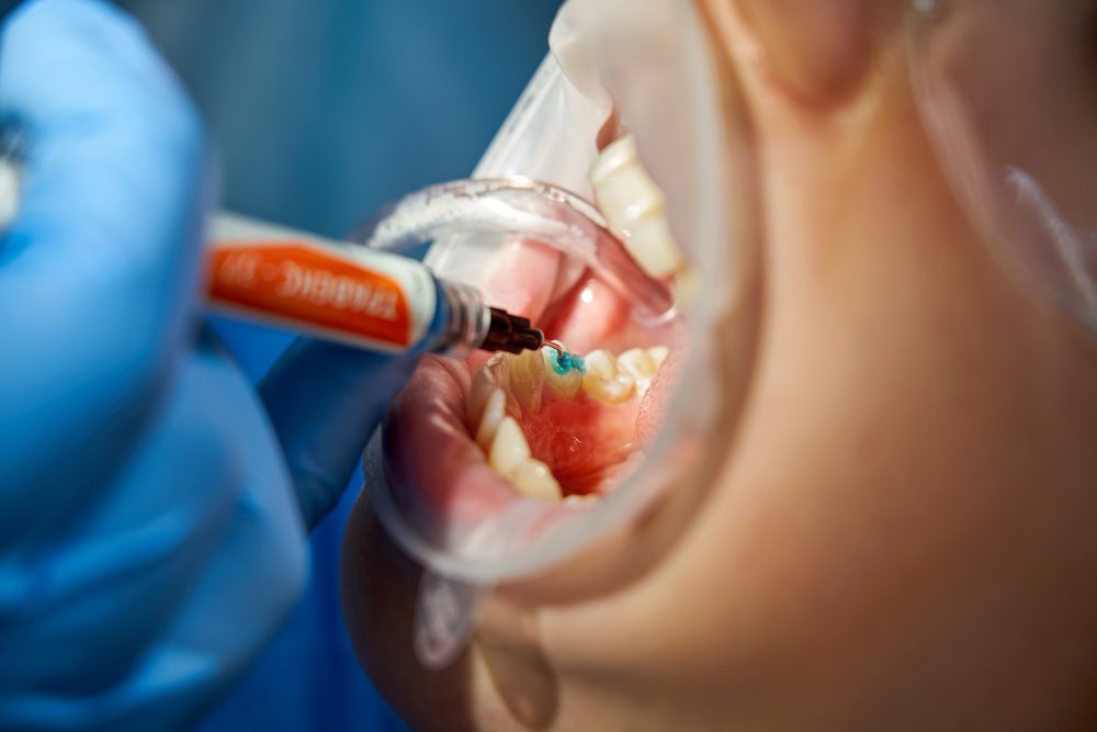 dental bonding or sealants